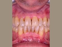 چراغ دوقلوی دندان پزشکی اسینو OSiNO dental twin light MK-016