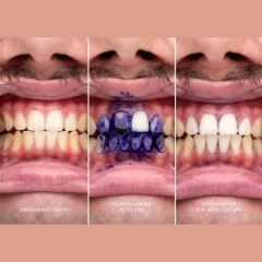 سرم تصحیح رنگ دندان های اسمایل Hismile مدل V34 بدون پراکسید